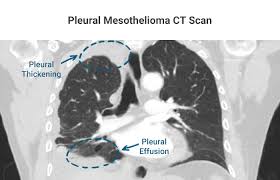 What Is Pleural Mesothelioma Full Overview What To Expect