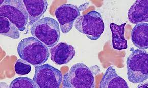 Check spelling or type a new query. La Leucemia Mieloide Cronica El Paradigma De La Importancia De La Investigacion Fundacion Josep Carreras Contra La Leucemia