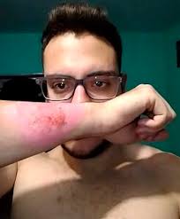 In a real perry mason moment, the si spokesperson 'fessed up and admitted that, yes, patrick had been cleaned up with a little photoshop work. Man Used Cheese Grater To Remove Arm Tattoo After New Job Has No Tattoos Policy Thecount Com