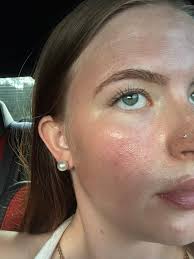 Dry and scaling skin with red spots