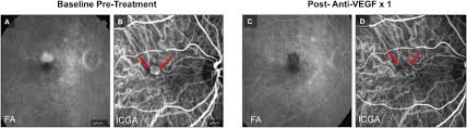Rated 4.5 out of 5 stars. Incomplete Response To Anti Vegf Therapy In Neovascular Amd Exploring Disease Mechanisms And Therapeutic Opportunities Sciencedirect