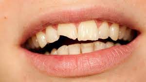 Chipped Tooth Garland, TX - Broken Teeth Treatment - Dental Filling