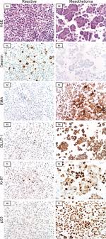 Mesothelial cells are not really something you think about unless a problem develops. The Use Of Immunohistochemistry To Distinguish Reactive Mesothelial Cells From Malignant Mesothelioma In Cytologic Effusions Hasteh 2010 Cancer Cytopathology Wiley Online Library