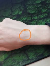 Knochen An Handgelenk Medizin Arzt Schmerzen