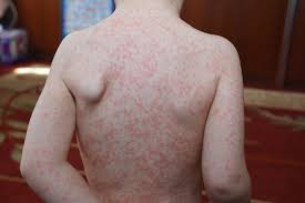 It is one of the most common human viruses. Pfeiffersches Drusenfieber Ebv Fakten Fur Betroffene