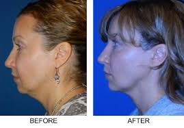 Check One Hour SMART Facelift Photos