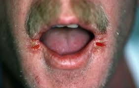 Image result for Angular Cheilitis