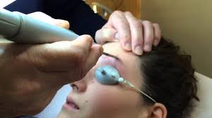 Epilation laser définitive à paris. Apparemment Fantastique Se Ruiner Epilation Laser Sourcil Semencesdusud Com