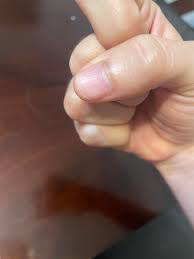 Image result for Nail Pitting