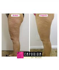 Maybe you would like to learn more about one of these? Velashape 111 Near Me 2021 Review