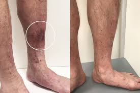 Image result for Pigment stains on the shin