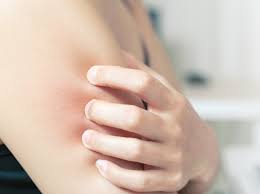 Achtung Diese Hautirritationen Sind Ein Neues Corona Symptom Freundin De