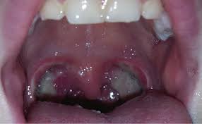 If tonsillitis happens to you a lot, the doctor may suggest you have an operation to remove your but how do doctors get the tonsils out of your throat? Racgp Post Tonsillectomy Management A Framework