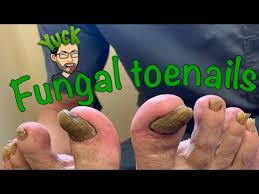 The infected nails often change color, becoming yellow, green, or black. Cutting Long Toenails With Fungus Youtube