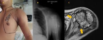 Osteosarcoma is a cancer that starts in the bones. Radical Change In Osteosarcoma Surgical Plan Due To Covid 19 Pandemic Bmj Case Reports