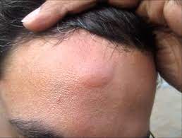 Der Kopf Juckt Stark Und Es Treten Beulen Auf Warum Erscheint Eine Beule Am Hinterkopf