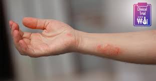 Image result for Erythrasma