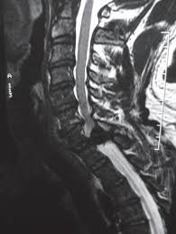 Scielo Brasil Delayed Traumatic Spinal Epidural Hematoma With Neurological Deficits Delayed Traumatic Spinal Epidural Hematoma With Neurological Deficits