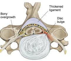 Maybe you would like to learn more about one of these? Cervical Radiculopathy Matthew D Hepler M D Spine Surgeon Florida