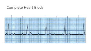 This is known as an escape rhythm. Third Degree Heart Block Youtube