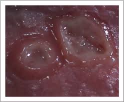 Image result for chancroid