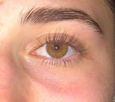 Tiefe Und Dunkle Augenringe Und Blaschen Haut Augen