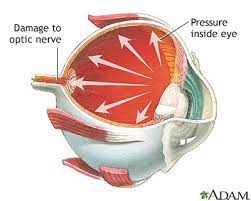 It's much more glaucoma is usually caused by fluid building up in the eye and increasing the pressure on the optic. Glaucoma Medlineplus Medical Encyclopedia