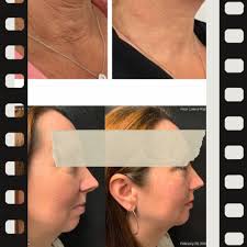 🌟 The Future of Skin Regeneration Has Arrived 🌟 Meet PEARL by AnteAGE® —  Exosomes with PDRN! ✨ This next-gen treatment harnesses powerhouse  exosomes, tiny messengers that supercharge your skin's healing and