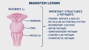 Image result for Neurologic Lesion Localization