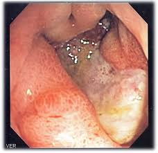 Le cancer de l'estomac est un cancer qui se forme dans les tissus qui tapissent l'estomac. Ulcere Gastro Duodenal Wikipedia