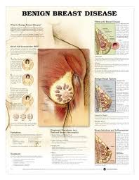 Benign Breast Disease Laminated Chart Lfa 99759