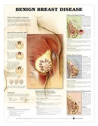 Benign Breast Disease Laminated Chart Lfa 99759