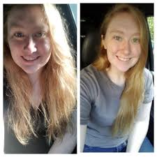 It's been 2 months and hair half grown in. Looking better.