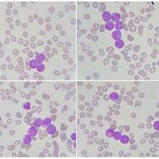 Pin On My Leukemia Battle