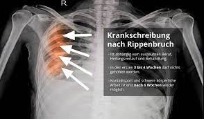 Wie Lange Wird Man Nach Rippenbruch Krankgeschrieben