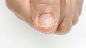 nails infections anemia psoriasis what nails can reveal