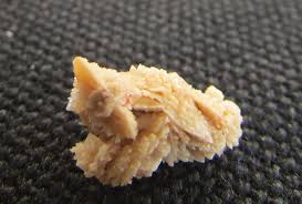 Kidney Stones What Are Kidney Stones Urologist Urology Austin