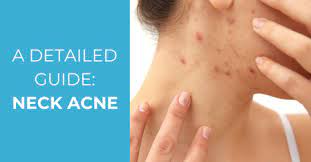 Causes Prevention And Treatment Of Neck Acne