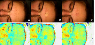 Apply pressure with a thumb or finger tip. Diffuse Reflectance Spectroscopy Getting The Capillary Refill Test Under One S Thumb Protocol