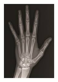 Image result for Hand Growth Plates