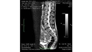 Bandscheibenvorfall L5 S1