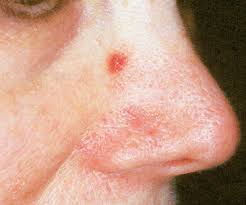 I have developed an uncontrollable, itch, red, patchy rash that is spreading. Cherry Angiomas Laser Treatments Dermatologist Dr Gergana Gallacher Dermatology And Laser Centre