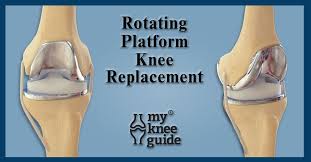 The Knee Prosthesis The Different Types Knee Replacement Knee Surgery Knee Replacement Surgery