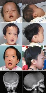 Image result for Craniotabes