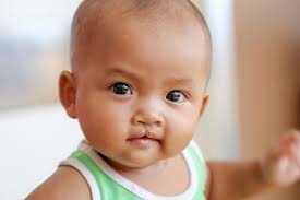 Image result for Cleft Lip