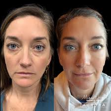 No more tired eyes 🤩 We added a little bit of cheek filler for support and  lift, and then put filler under her eyes (tear trough). What do you think  of this