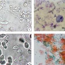 1000 x 1000 jpeg 701 кб. T Vaginalis In Direct Microscopy 400x 2 T Vaginalis In Giemsa Download Scientific Diagram