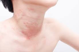 The Range Of Allergic Reactions My Kids Food Allergies