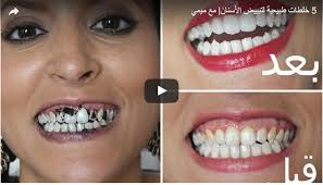 خراج الاسنان Archives لحن الحياة