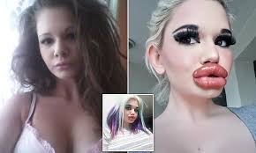 Woman 22 Who Has Spent Thousands Quadrupling The Size Of Her Lips Undergoes Her 20th Injection Daily Mail Online She and the romanian singer costi ionita performed together and released music as sahara. her lips undergoes her 20th injection